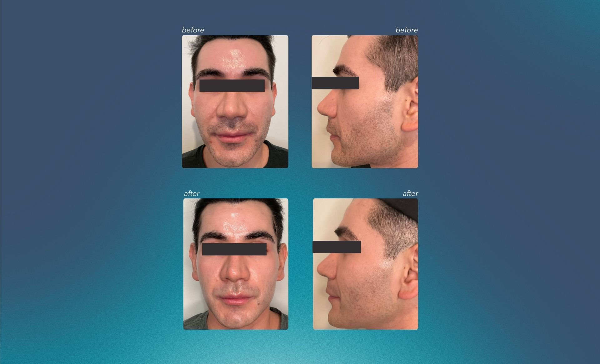 Before and After Front and Side Images for Micro-Needling